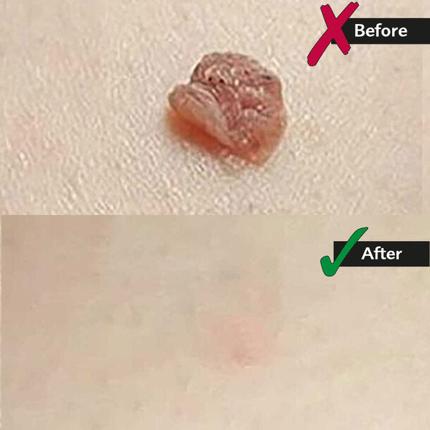 Skin Tag Removal Kit | Made In United Kingdom طقم إزالة الزوائد الجلدية | صنع بريطاني
