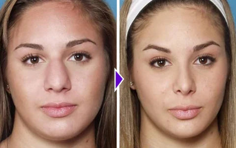 Nose Sculpting Device جهاز نحت الأنف