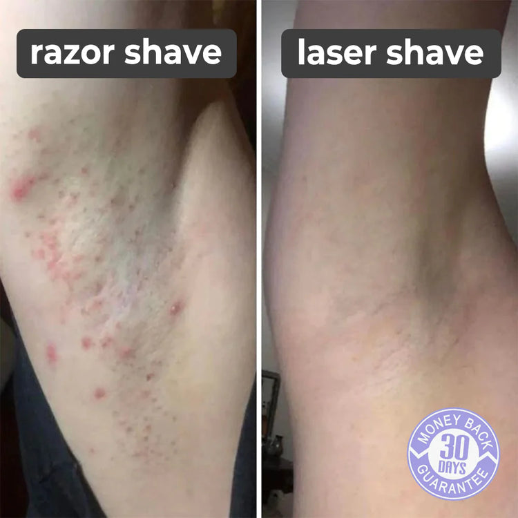 SMARTEK® LASER SHAVER ماكينة الحلاقة بالليزر