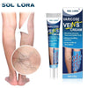 Varicose veins